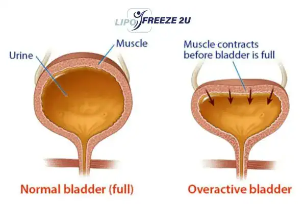 diagram of overactive bladder treatment Bracknell