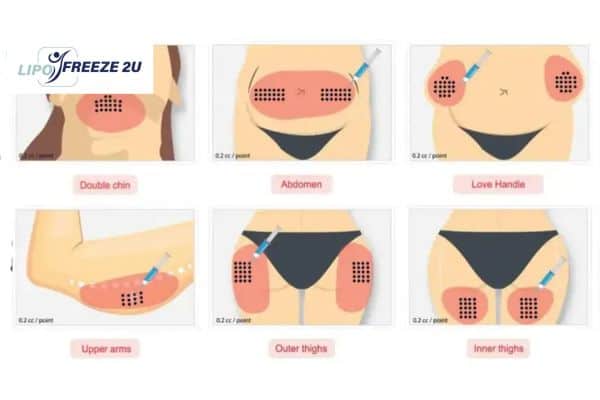Benefits of Choosing Aqualyx for Fat Reduction Bracknell