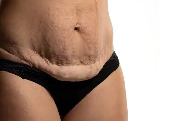loose skin after weight loss injections Bracknell