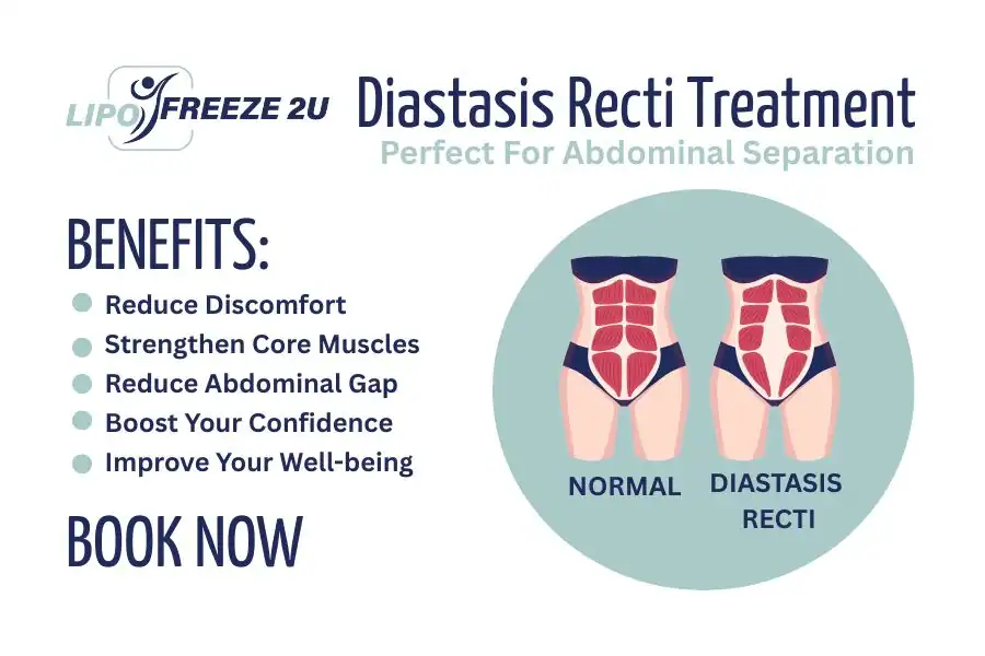 How Long Will It Take to See Improvements in Diastasis Recti Bracknell