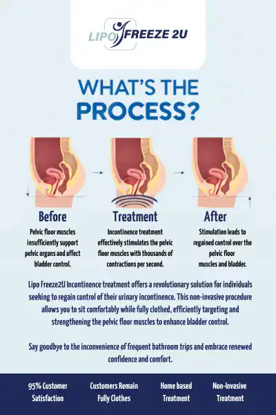 Diagram of how incontinence treatment Bracknell works.