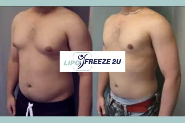 How Long Does It Take to See Results Bracknell?