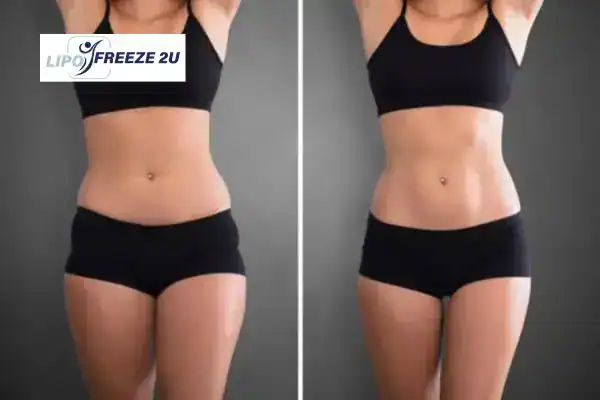 How Can LIPO FREEZE 2U Support Your Post-Pregnancy Body Recovery Bracknell?