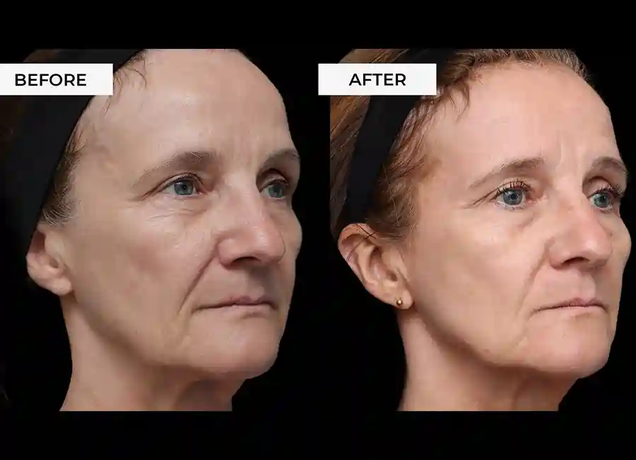 How Many RF Microneedling Sessions Will You Need to See a Difference Bracknell?
