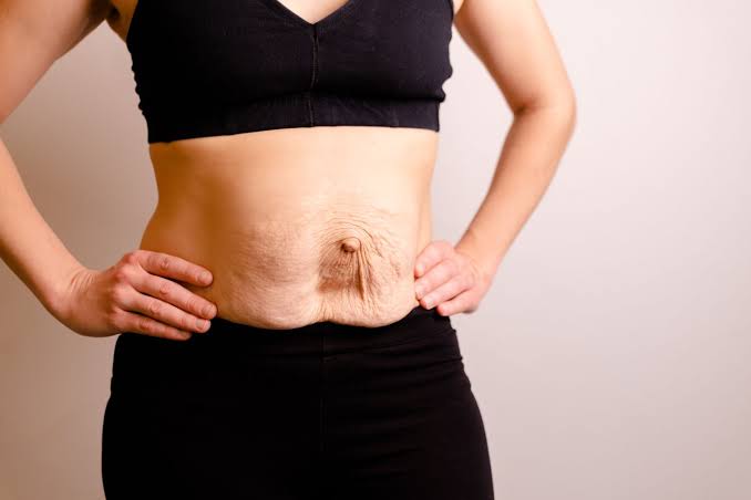 Is Surgery Really the Only Way to Repair Diastasis Recti Bracknell?