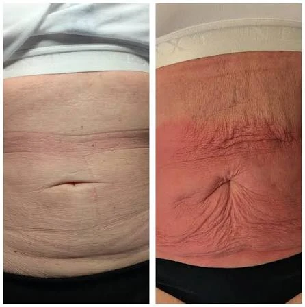 How Does RF Microneedling Improve Crepey, Thin and Uneven Skin Texture Bracknell?