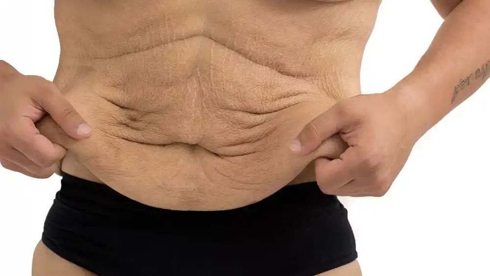 Why Does Weight Loss Medication Leave Some People With Loose or Sagging Skin Bracknell?
